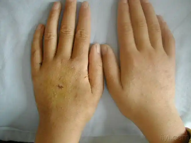 小孩手背毛囊角化症