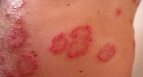 起初的皮疹为红斑,以后为小点状突起的皮疹或有水疱样疹(医学上称丘疹