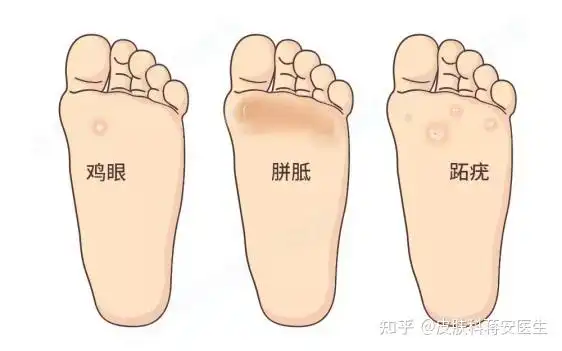 鸡眼和跖疣到底怎么区别?