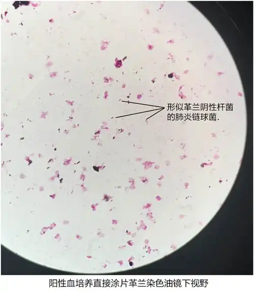 "变脸高手" —— 阳性血培养中的肺炎链球菌_临床实验室_期刊文章