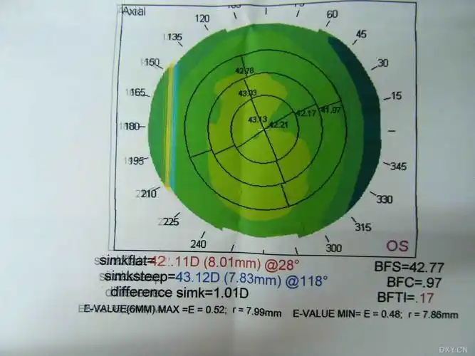 【分享】角膜地形图
