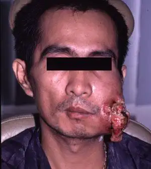 吃槟榔有那些害处