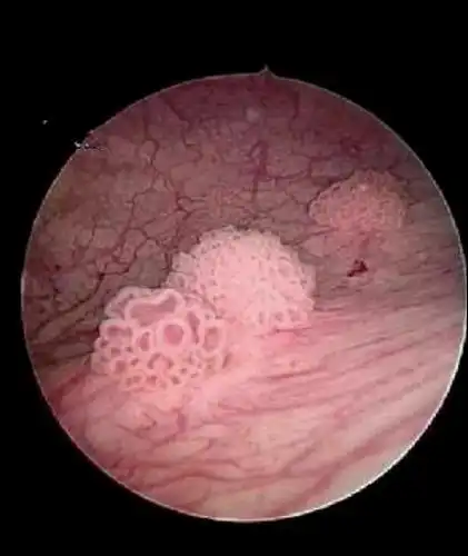 带您了解膀胱肿瘤那些事