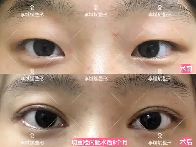 切重睑内眦4月 (10).jpg