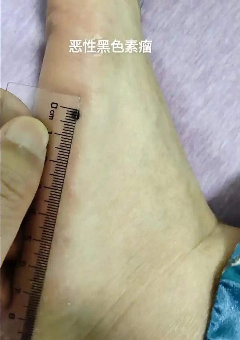 不会有人不知道 #痣 #黑色素瘤 就是皮肤肿瘤吧….良性叫 - 抖音