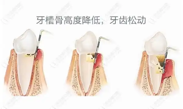 怎样判断牙槽骨吸收程度收下牙槽骨吸收的诊断标准全搞懂