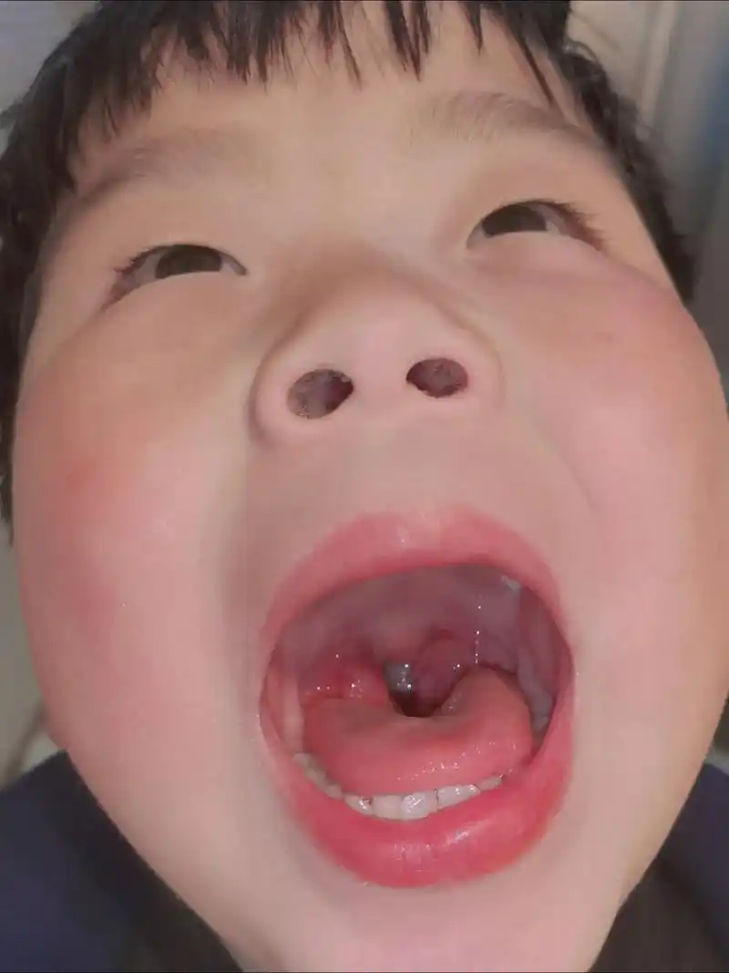 扁桃体3度肥大 夜里睡觉打呼噜,鼻子呼气不痛快 憋气,医生建 - 抖音