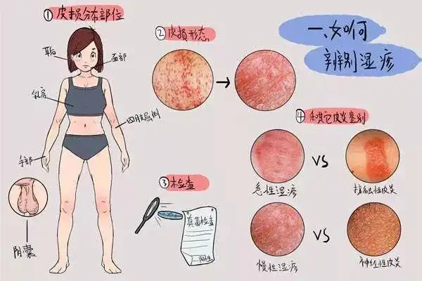 中医针灸治疗湿疹