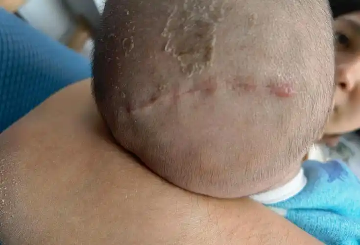 颅缝早闭——治疗篇_狭颅症_狭颅症治疗方式 - 好大夫在线