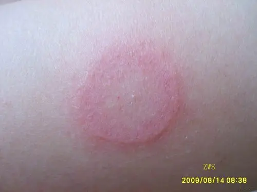 离心性环状红斑