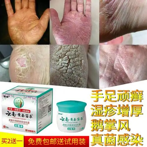 治疗鹅掌风手癣膏手足癣汗疱疹手部干裂脱皮真菌感染的专用藓药膏