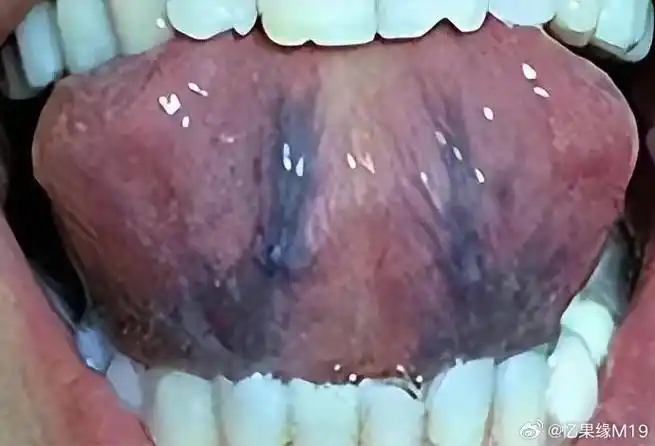 人伸出舌头,舌面暗紫,舌下青筋很明显,又粗又紫,那这说明体内有淤血了