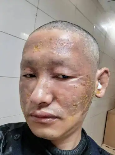 明星脸遭毁容真相让人心疼