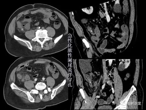 开课了急性阑尾炎的ct诊断及鉴别诊断