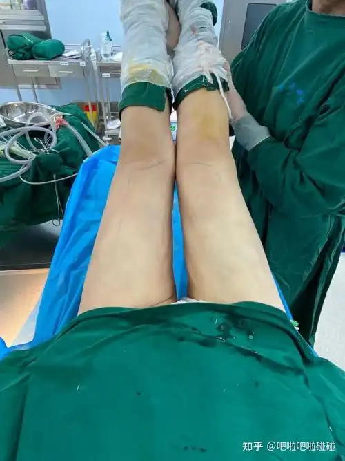 记录抽脂全过程 - 知乎