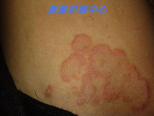 源源护理中心的优惠券大全—癣肤王药膏皮肤病专用治疗手癣真菌感染