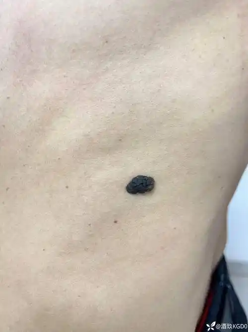黑色素痣