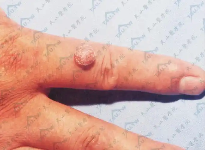 圆形,高出皮面,表面角化,粗糙不平,色灰黄或污黄,呈乳头样疣状增殖