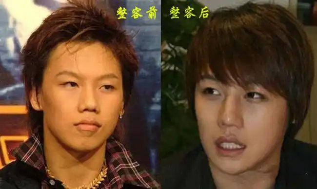 刘维整容前后照片真的太悬殊声音太娘被质疑很gay