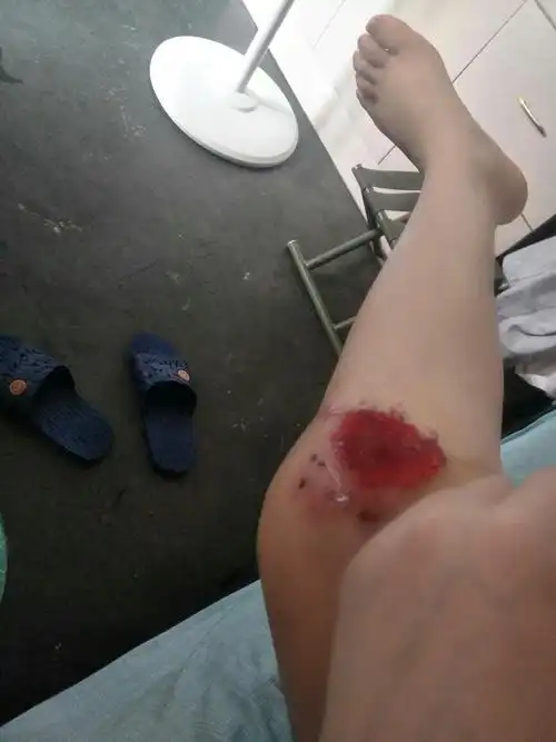 腿上的创伤 去医院医生说不用包扎 给开了盒百多邦 为什么擦了百多邦