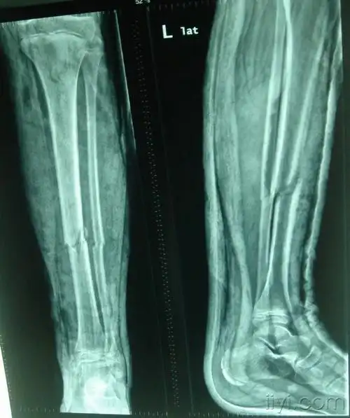 病例讨论14岁男孩左胫腓骨骨折复位石膏外固定后