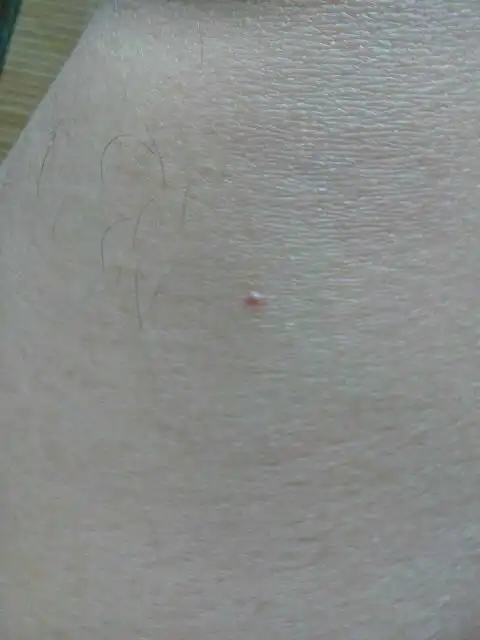 问:有乙肝,肝功能正常,身上有很多针眼大少的小红点,有好几年了,最近