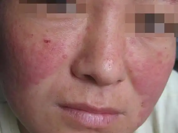 target="_blank" href="/item/系统性红斑狼疮/811510" data-lemmaid=