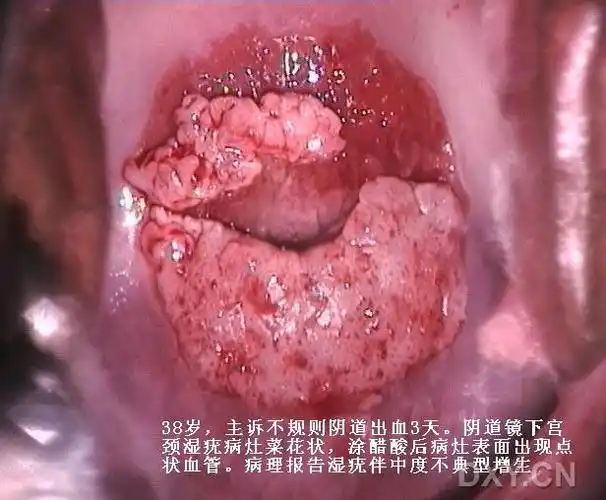 【共享】尖锐湿疣高清图片