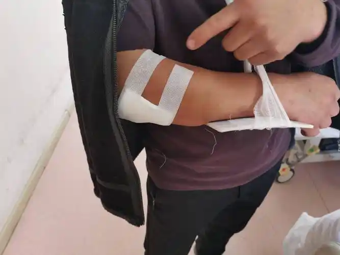 他自己觉得右臂有点肿胀疼痛,拍了片子后发现,胳膊轻微骨折,打了石膏