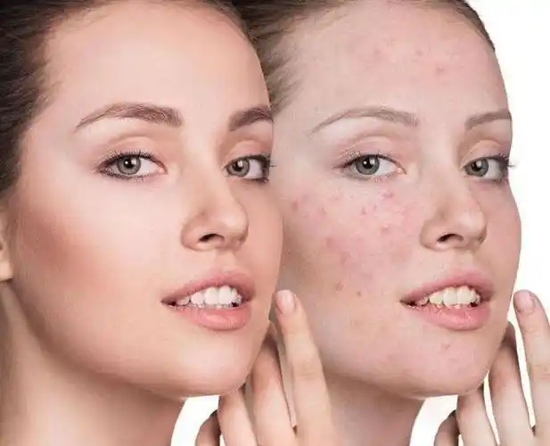 有没有感染hpv女人的脸不骗人若有4个丑态或是hpv上门