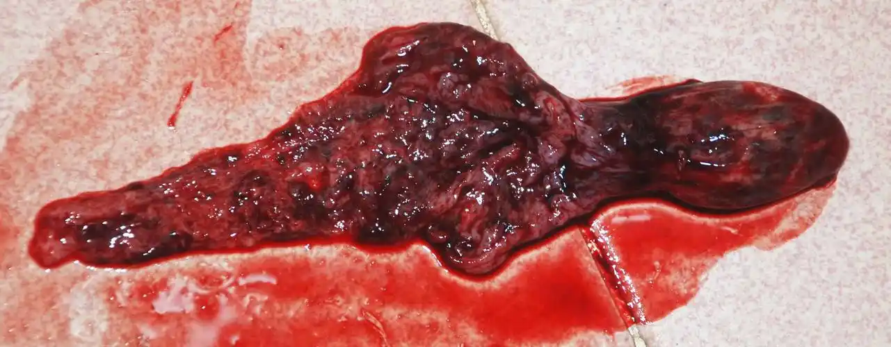 阴道子宫内流出像鱼泡一样的东西