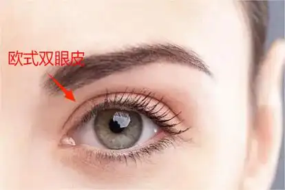 欧式双眼皮效果图片_寻医问药频道_寻医问药网