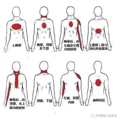 部分病例可放射至左上臂尺侧,下颌,颈部,上背部;疼痛:胸骨后或心前区