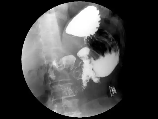 5 分钟读懂消化道造影片(胃篇)