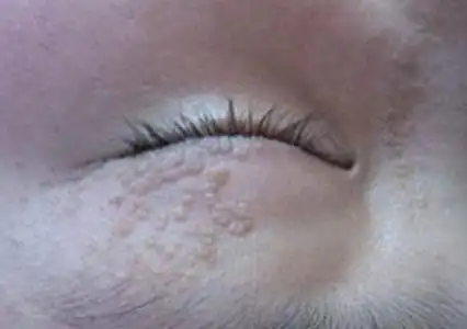 眼部扁平疣的症状和治疗方法保护好心灵的窗户