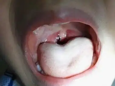 小儿疱疹性咽峡炎咽峡明显红肿图