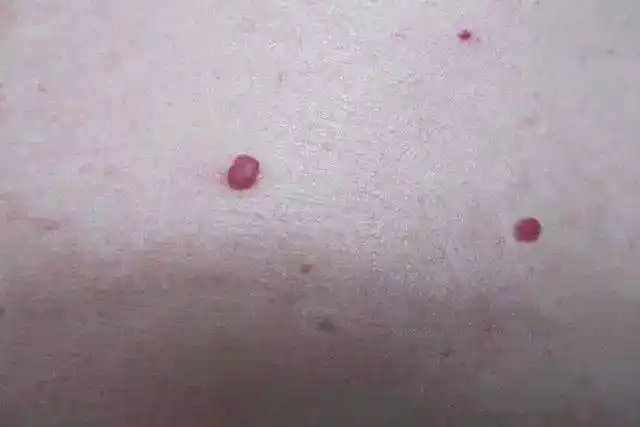 身上长出这种"小红点"要重视,肝功能正常也可能存在肝损伤!