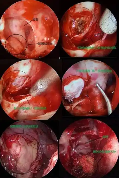 辽宁省细胞生物学学会人工智能鼻内镜微创外科专委会提供