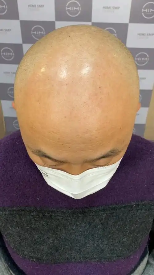 纹发脱发严重成这样了头顶光秃秃的基本没有头发怎么修复形象