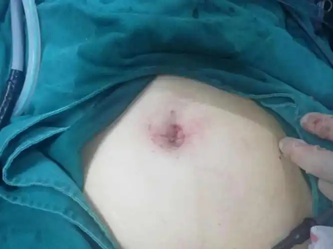 临夏州首例单孔腹腔镜下子宫肌瘤剥除术