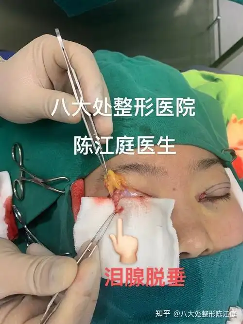 为什么会出现泪腺脱垂的状况? - 知乎