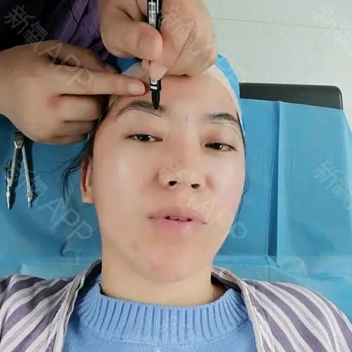 氧气9648241527496104切眉术第1天美丽日记