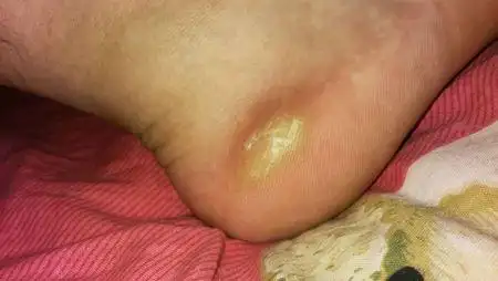 请专业的医师回答:我的右脚后跟起了一个黄白色的痂,上边泛着死皮,不