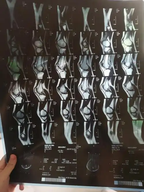 半月板撕裂  #半月板损伤  #半月板康复  #膝盖软骨退化  #膝盖积液