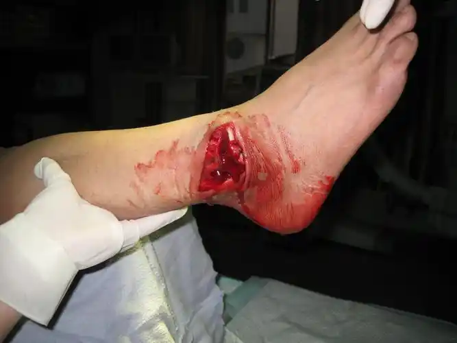 踝关节 开放性 粉碎性骨折伴脱位