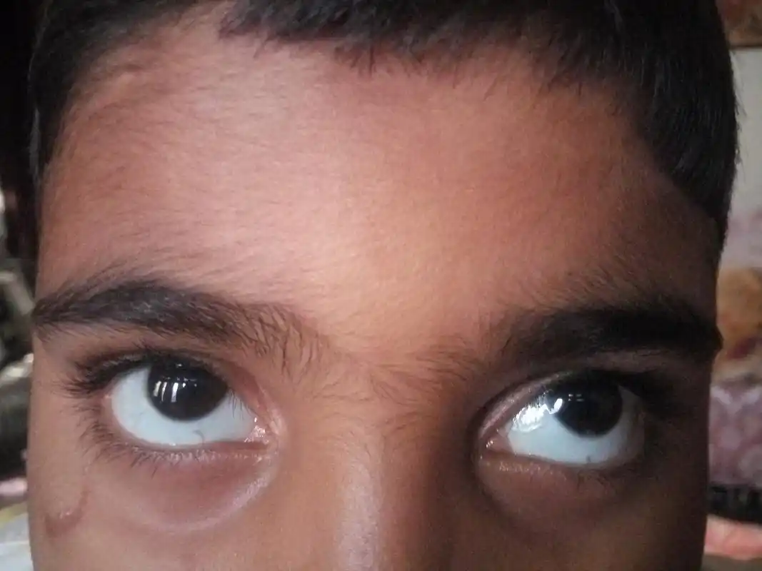 整形手术可以在一定程度上改善以及缓解由甲亢引起的眼突.