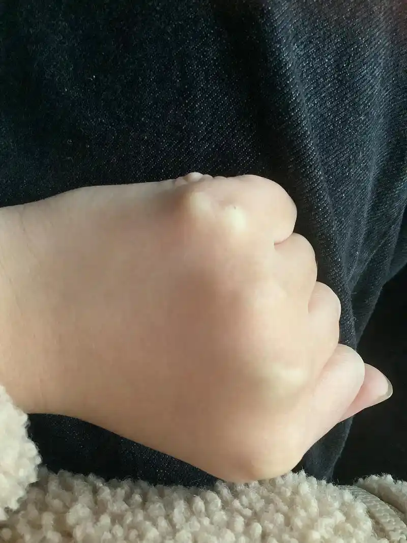 手上多长了一个小骨头是怎么回事啊