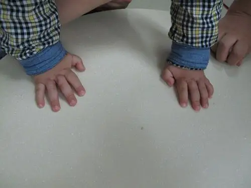 双翼皮瓣成形指蹼-——并指不植皮或减少植皮的新方法 - 好大夫在线