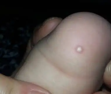 宝宝7个月,脚后跟起了个小白疙瘩,大约半个月了,请教专家?