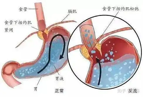 的名字,其实就是胃中的胃液(或胃液和食物的混合物)往食道的方向逆流